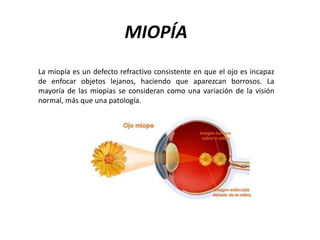 MIOPÍA
La miopía es un defecto refractivo consistente en que el ojo es incapaz
de enfocar objetos lejanos, haciendo que aparezcan borrosos. La
mayoría de las miopías se consideran como una variación de la visión
normal, más que una patología.
 