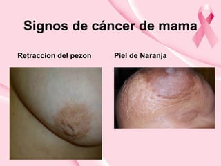 Signos de cáncer de mama
Retraccion del pezon Piel de Naranja
 