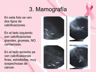 3. Mamografía
En esta foto se ven
dos tipos de
calcificaciones.
En el lado izquierdo
son calcificaciones
grandes, gruesas, NO
cancerosas.
En el lado derecho se
ven calcificaciones
finas, estrelladas, muy
sospechosas de
cáncer.
 