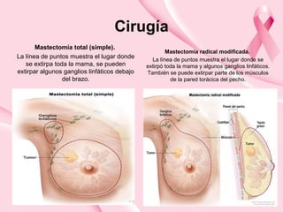Cirugía
Mastectomía total (simple).
La línea de puntos muestra el lugar donde
se extirpa toda la mama, se pueden
extirpar algunos ganglios linfáticos debajo
del brazo.
Mastectomía radical modificada.
La línea de puntos muestra el lugar donde se
extirpó toda la mama y algunos ganglios linfáticos.
También se puede extirpar parte de los músculos
de la pared torácica del pecho.
 