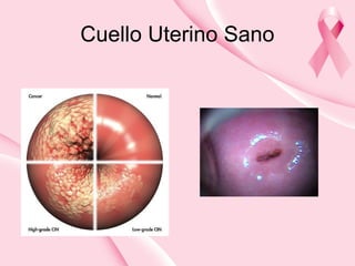 Cuello Uterino Sano
 