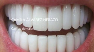 CAMILA ÁLVAREZ HERAZO
Carillas dentales
 