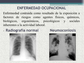 ENFERMEDAD OCUPACIONAL
Enfermedad contraída como resultado de la exposición a
factores de riesgos como agentes físicos, químicos,
biológicos, ergonómicos, psicológicos y sociales
inherentes a la actividad laboral.
. Radiografía normal Neumoconiosis
 