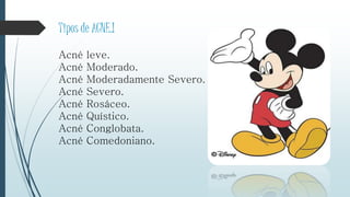 Tipos de ACNE.!
Acné leve.
Acné Moderado.
Acné Moderadamente Severo.
Acné Severo.
Acné Rosáceo.
Acné Quístico.
Acné Conglobata.
Acné Comedoniano.
 