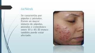Acné Moderado.
Se caracteriza por
pápulas y pústulas.
Existe un mayor
número de pápulas,
pústulas y comedones
entre 10 y 40. El tronco
también puede estar
afectado.
 