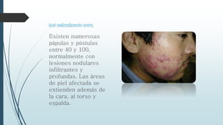 Acné moderadamente severo.
Existen numerosas
pápulas y pústulas
entre 40 y 100,
normalmente con
lesiones nodulares
infiltrantes y
profundas. Las áreas
de piel afectada se
extienden además de
la cara, al torso y
espalda.
 