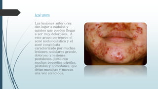 Acné severo.
Las lesiones anteriores
dan lugar a nódulos y
quistes que pueden llegar
a ser muy dolorosos. A
este grupo pertenece el
acné noduloquístico y el
acné conglobata
caracterizado por muchas
lesiones nodulares grande,
doloroso y lesiones
pustulosas; junto con
muchas pequeñas pápulas,
pústulas y comedones, que
dejan manchas y marcas
una vez atendidos.
 