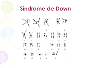 Sindrome de Down 