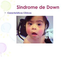 Sindrome de Down Características Clínicas 