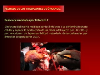 RECHAZO DE LOS TRASPLANTES DE ÓRGANOS.
Reacciones mediadas por linfocitos T
El rechazo del injerto mediado por los linfocitos T se denomina rechazo
celular y supone la destrucción de las células del injerto por LTC CD8+ y
por reacciones de hipersensibilidad retardada desencadenadas por
linfocitos cooperadores CD4+.
 