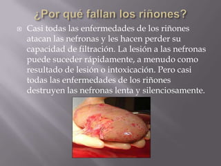    Casi todas las enfermedades de los riñones
    atacan las nefronas y les hacen perder su
    capacidad de filtración. La lesión a las nefronas
    puede suceder rápidamente, a menudo como
    resultado de lesión o intoxicación. Pero casi
    todas las enfermedades de los riñones
    destruyen las nefronas lenta y silenciosamente.
 