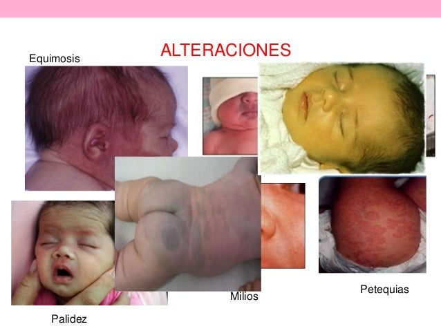 Valoración del RN, Bienestar y Test de Apgar