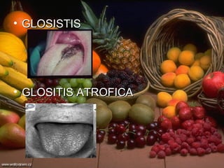 GLOSISTIS GLOSITIS ATROFICA 