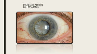 COMO SE VE ALGUIEN
CON CATARATAS:
 
