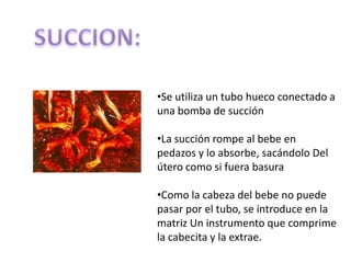 •Se utiliza un tubo hueco conectado a
una bomba de succión

•La succión rompe al bebe en
pedazos y lo absorbe, sacándolo Del
útero como si fuera basura

•Como la cabeza del bebe no puede
pasar por el tubo, se introduce en la
matriz Un instrumento que comprime
la cabecita y la extrae.
 