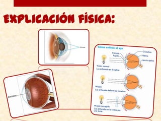 Cansancio ocularpatogénesisfactores genéticosLa propensión a la miopía de hijos de padres miopes es alta. Factores ambientalesclasificación