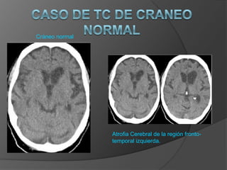 Cráneo normal

Atrofia Cerebral de la región frontotemporal izquierda.

 