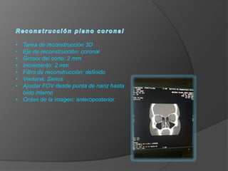•
•
•
•
•
•
•

Tarea de reconstrucción 3D
Eje de reconstrucción: coronal
Grosor del corte: 2 mm
Incremento: 2 mm
Filtro de reconstrucción: definido
Ventana: Senos
Ajustar FOV desde punta de nariz hasta
oído interno
• Orden de la imagen: anteroposterior

 