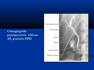 Colangiografía
postoperatoria oblicua
AP, posición OPD
 