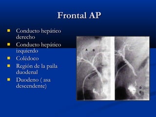Frontal APFrontal AP
 Conducto hepáticoConducto hepático
derechoderecho
 Conducto hepáticoConducto hepático
izquierdoizquierdo
 ColédocoColédoco
 Región de la pailaRegión de la paila
duodenalduodenal
 Duodeno ( asaDuodeno ( asa
descendente)descendente)
 