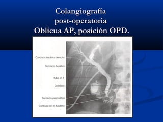 ColangiografíaColangiografía
post-operatoriapost-operatoria
Oblicua AP, posición OPD.Oblicua AP, posición OPD.
 