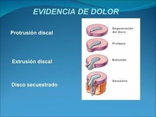 Protrusión discal Extrusión discal Disco secuestrado EVIDENCIA DE DOLOR 