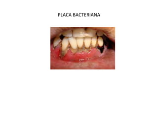 PLACA BACTERIANA
 