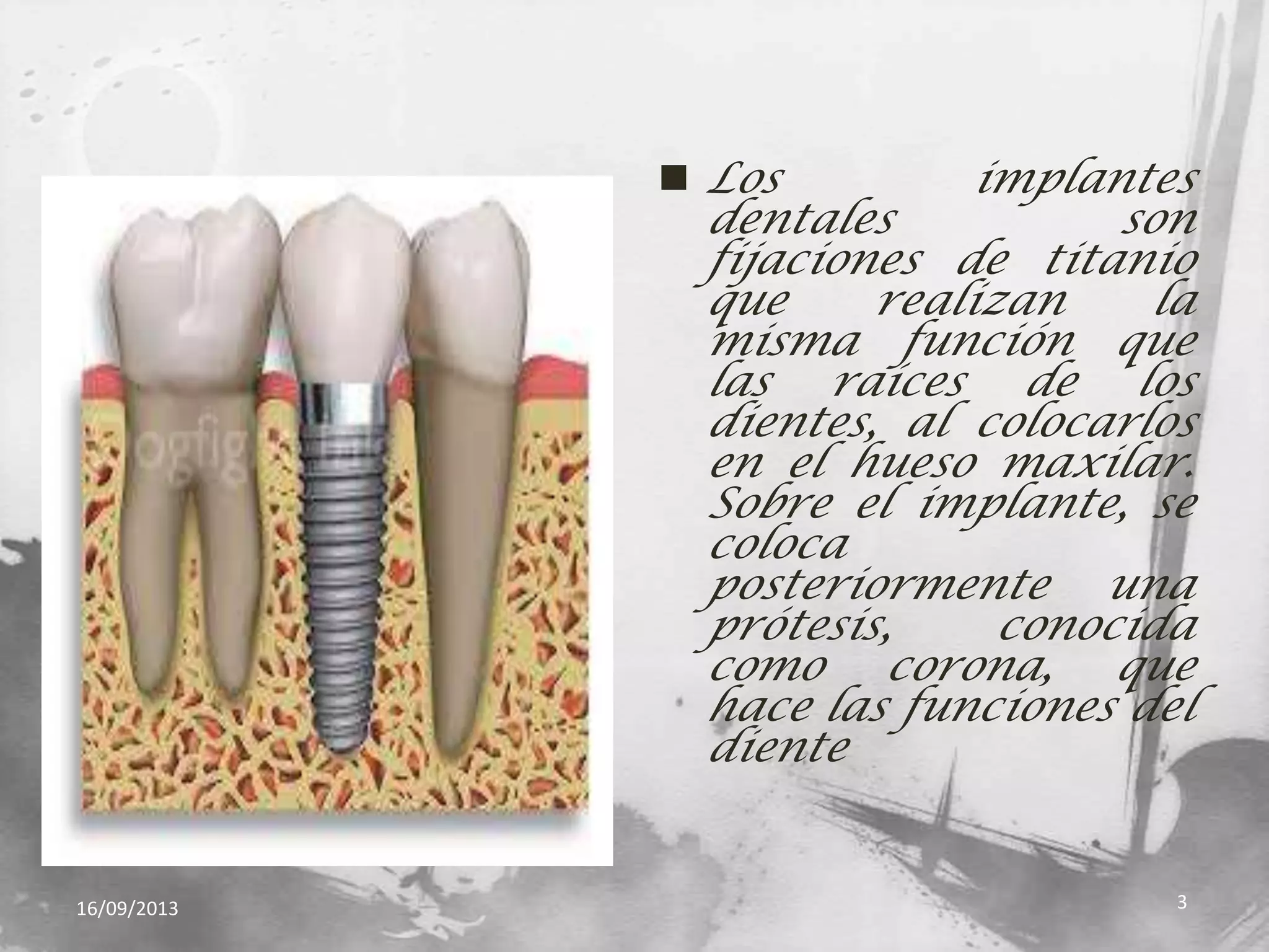  Los implantes
dentales son
fijaciones de titanio
que realizan la
misma función que
las raíces de los
dientes, al colocarlos
en el hueso maxilar.
Sobre el implante, se
coloca
posteriormente una
prótesis, conocida
como corona, que
hace las funciones del
diente
16/09/2013 3
 