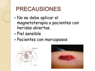 PRECAUSIONES
 No se debe aplicar el
magnetoterapia a pacientes con
heridas abiertas.
 Piel sensible
 Pacientes con marcapasos
 