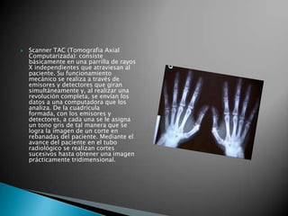    Scanner TAC (Tomografia Axial
    Computarizada): consiste
    básicamente en una parrilla de rayos
    X independientes que atraviesan al
    paciente. Su funcionamiento
    mecánico se realiza a través de
    emisores y detectores que giran
    simultáneamente y, al realizar una
    revolución completa, se envían los
    datos a una computadora que los
    analiza. De la cuadrícula
    formada, con los emisores y
    detectores, a cada una se le asigna
    un tono gris de tal manera que se
    logra la imagen de un corte en
    rebanadas del paciente. Mediante el
    avance del paciente en el tubo
    radiológico se realizan cortes
    sucesivos hasta obtener una imagen
    prácticamente tridimensional.
 
