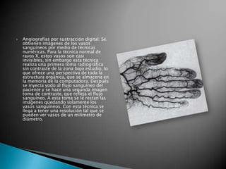    Angiografías por sustracción digital: Se
    obtienen imágenes de los vasos
    sanguíneos por medio de técnicas
    numéricas. Para la técnica normal de
    rayos X, estos vasos son casi
    invisibles, sin embargo esta técnica
    realiza una primera toma radiográfica
    sin contraste de la zona bajo estudio, lo
    que ofrece una perspectiva de toda la
    estructura orgánica, que se almacena en
    la memoria de la computadora. Después
    se inyecta yodo al flujo sanguíneo del
    paciente y se hace una segunda imagen
    toma de contraste, que refleja el flujo
    sanguíneo. A esta toma se le restan las
    imágenes quedando solamente los
    vasos sanguíneos. Con esta técnica se
    llega a tener una resolución tal que se
    pueden ver vasos de un milímetro de
    diámetro.
 