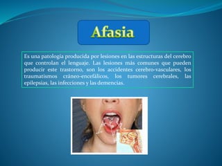 Es una patología producida por lesiones en las estructuras del cerebro
que controlan el lenguaje. Las lesiones más comunes que pueden
producir este trastorno, son los accidentes cerebro-vasculares, los
traumatismos cráneo-encefálicos, los tumores cerebrales, las
epilepsias, las infecciones y las demencias.
 