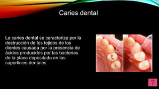 Caries dental
La caries dental se caracteriza por la
destrucción de los tejidos de los
dientes causada por la presencia de
ácidos producidos por las bacterias
de la placa depositada en las
superficies dentales.
 