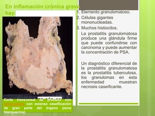 1. Elemento granulomatoso.
2. Células gigantes
mononucleadas.
3. Muchos histiocitos.
• La prostatitis granulomatosa
produce una glándula firme
que puede confundirse con
carcinoma y puede aumentar
la concentración de PSA.
• Un diagnóstico diferencial de
la prostatitis granulomatosa
es la prostatitis tuberculosa,
los granulomas en esta
enfermedad muestran
necrosis caseificante.
En inflamación crónica grave
hay:
Corte transversal de próstata con
tuberculosis con extensa caseificación
de gran parte del órgano (zona
blanquecina).
 