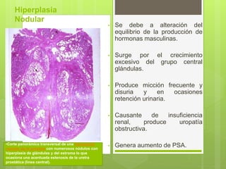 • Se debe a alteración del
equilibrio de la producción de
hormonas masculinas.
• Surge por el crecimiento
excesivo del grupo central
glándulas.
• Produce micción frecuente y
disuria y en ocasiones
retención urinaria.
• Causante de insuficiencia
renal, produce uropatía
obstructiva.
• Genera aumento de PSA.
Hiperplasia
Nodular
•Corte panorámico transversal de una hiperplasia
nodular de la próstata con numerosos nódulos con
hiperplasia de glándulas y del estroma lo que
ocasiona una acentuada estenosis de la uretra
prostática (línea central).
 