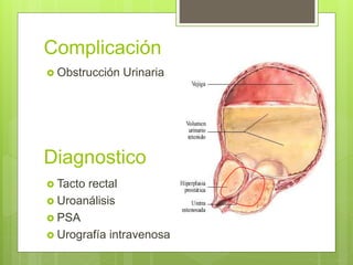 Complicación
 Obstrucción Urinaria
Diagnostico
 Tacto rectal
 Uroanálisis
 PSA
 Urografía intravenosa
 