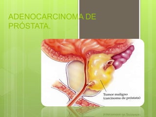 ADENOCARCINOMA DE
PRÓSTATA.
 