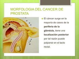 MORFOLOGIA DEL CANCER DE
PROSTATA
 El cáncer surge en la
mayoría de casos de la
periferia de la
glándula, tiene una
localización posterior
por tal razón puede
palparse en el tacto
rectal.
 