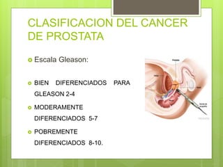 CLASIFICACION DEL CANCER
DE PROSTATA
 Escala Gleason:
 BIEN DIFERENCIADOS PARA
GLEASON 2-4
 MODERAMENTE
DIFERENCIADOS 5-7
 POBREMENTE
DIFERENCIADOS 8-10.
 