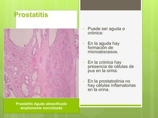 • Puede ser aguda o
crónica:
• En la aguda hay
formación de
microabscesos.
• En la crónica hay
presencia de células de
pus en la orina.
• En la prostatodinia no
hay células inflamatorias
en la orina.
Prostatitis
Prostatitis Aguda absecificada
ampliamente necrotizada
 