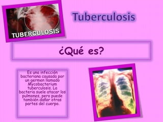 ¿Qué es?
     Es una infección
 bacteriana causada por
   un germen llamado
     Mycobacterium
     tuberculosis. La
bacteria suele atacar los
  pulmones, pero puede
  también dañar otras
   partes del cuerpo.
 