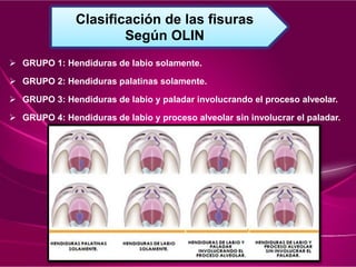  GRUPO 1: Hendiduras de labio solamente.
 GRUPO 2: Hendiduras palatinas solamente.
 GRUPO 3: Hendiduras de labio y paladar involucrando el proceso alveolar.
 GRUPO 4: Hendiduras de labio y proceso alveolar sin involucrar el paladar.
Clasificación de las fisuras
Según OLIN
 
