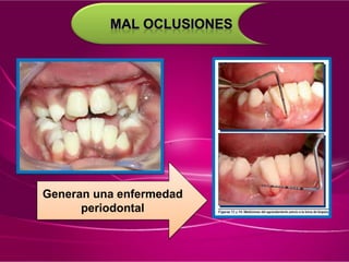 Generan una enfermedad
periodontal
D
C
 