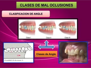 CLASE II división 2
Clases de Angle
 