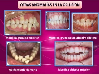 Mordida cruzada anterior Mordida cruzada unilateral y bilateral
Apiñamiento dentario Mordida abierta anterior
 