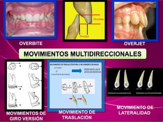 OVERBITE OVERJET
MOVIMIENTO DE
TRASLACIÓN
MOVIMIENTOS DE
GIRO VERSIÓN
MOVIMIENTO DE
LATERALIDAD
 