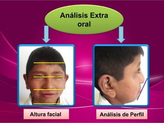 Análisis Extra
oral
Altura facial Análisis de Perfil
 