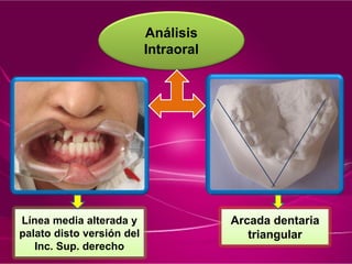 Análisis
Intraoral
Línea media alterada y
palato disto versión del
Inc. Sup. derecho
Arcada dentaria
triangular
 