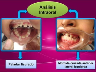 Análisis
Intraoral
Paladar fisurado Mordida cruzada anterior
lateral izquierda
 