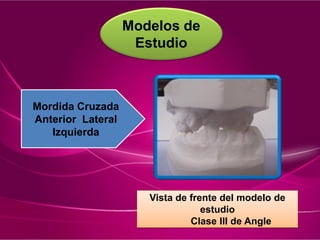 Modelos de
Estudio
Vista de frente del modelo de
estudio
Clase III de Angle
Mordida Cruzada
Anterior Lateral
Izquierda
 